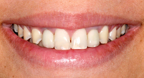 Implant