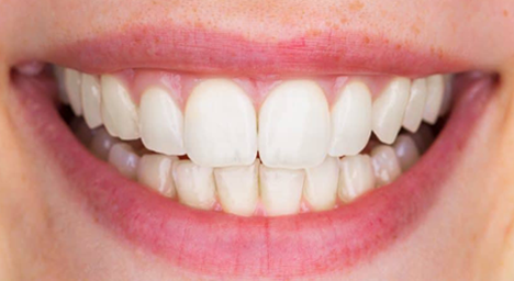 Whitening
