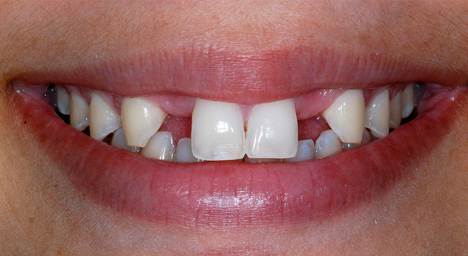 Implant