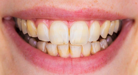 Whitening